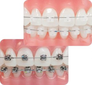 Read more about the article Niềng răng mắc cài 3M UGSL là gì? có tốt không?