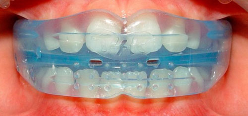 Niềng răng silicon giúp hạn chế tối đa tình trạng răng mọc lệch