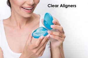 Read more about the article Niềng răng trong suốt Clear Aligner là gì? có hiệu quả không?