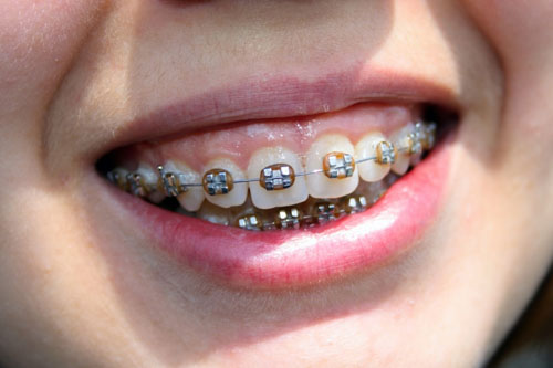 Niềng răng trong trường hợp hô có nguyên nhân do răng