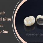 Quy trình bọc răng sứ Titan chuẩn và điều cần lưu ý