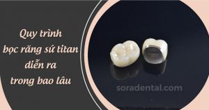 Read more about the article Quy trình bọc răng sứ Titan chuẩn và điều cần lưu ý