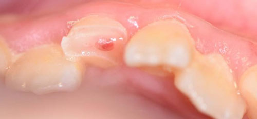 Răng chấn thương chạm tủy răng