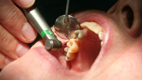 Răng đã chữa tủy cần bọc răng sứ để bảo tồn