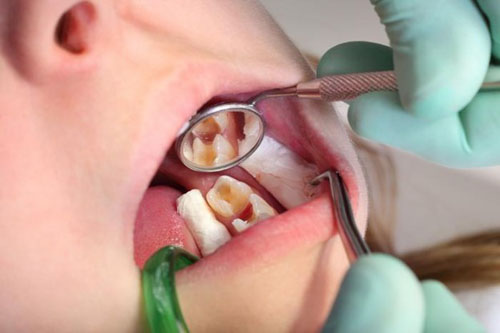 Răng sâu chạm tủy cần phải điều trị nội nha