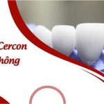 Răng sứ Cercon có tốt không?