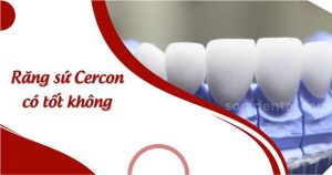 Read more about the article Răng sứ Cercon có tốt không?