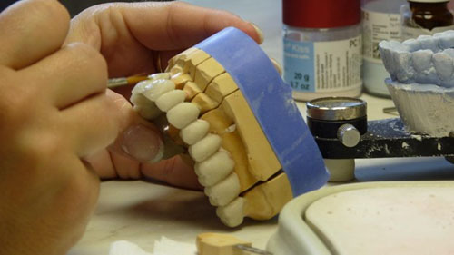 Răng sứ có đa dạng các loại toàn sứ, răng sứ kim loại