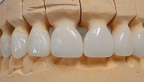 Răng toàn sứ Hi – Zirconia