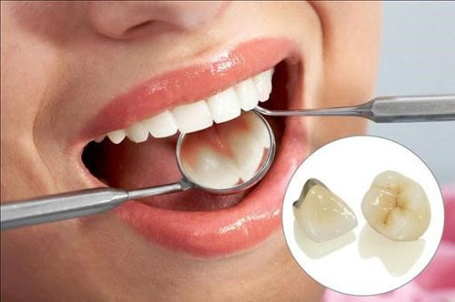 Tại sao cần chăm sóc răng sứ tốt sau khi bọc?