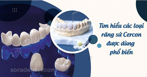 Tìm hiểu các loại răng sứ Cercon được dùng phổ biến