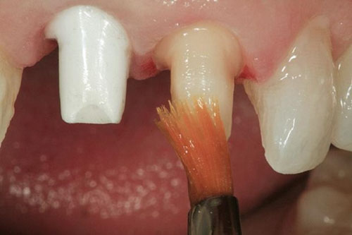 Tìm hiểu về giải pháp bọc răng sứ thẩm mỹ