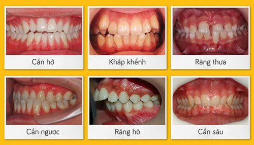Tình trạng răng miệng cũng ảnh hưởng nhiều đến chi phí niềng răng