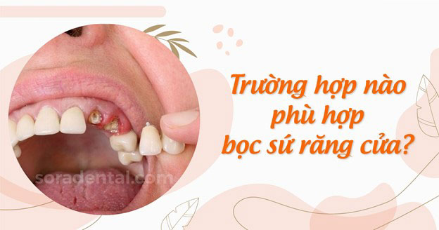 Read more about the article Trường hợp nào nên bọc sứ răng cửa? Áp dụng khi nào?