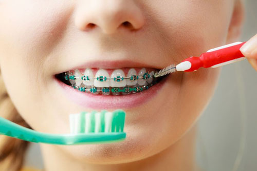 Vệ sinh răng miệng đúng cách khi niềng răng vô cùng quan trọng