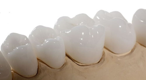 Các loại răng sứ không kim loại