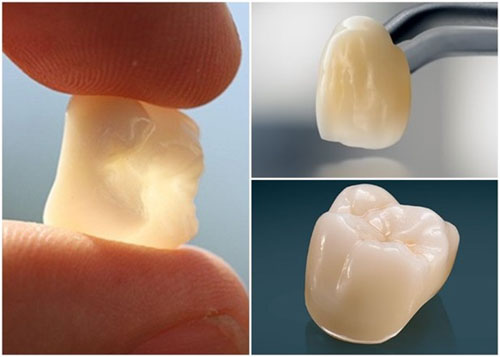 Răng sứ Emax được ưa chuộng sử dụng