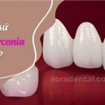 So sánh đặc điểm khác biệt giữa răng sứ Zirconia và Cercon