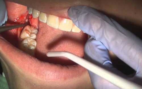 Các tình trạng xảy ra sau khi nhổ răng