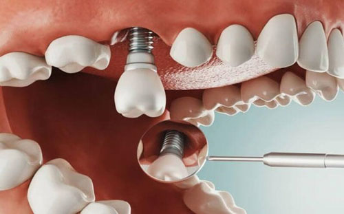 Cấy ghép răng Implant hiện đại