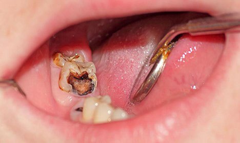 Chỉ định nhổ răng khi răng sâu nghiêm trọng