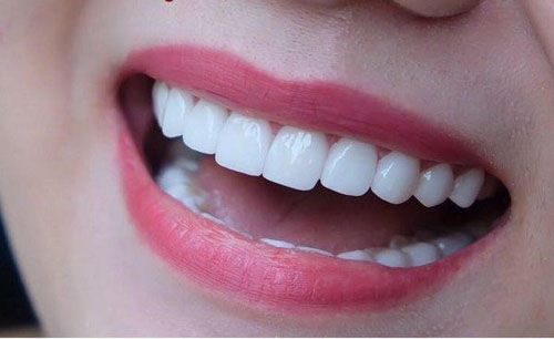 Đảm bảo tính thẩm mỹ cho răng