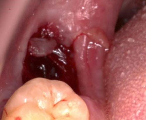 Dấu hiệu răng khôn sau khi nhổ bị nhiễm trùng