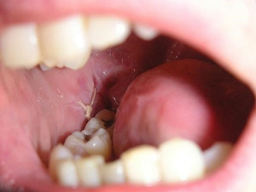 Hồi phục vết thương sau nhổ răng khôn theo từng giai đoạn