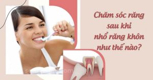 Read more about the article Hướng dẫn cách chăm sóc răng sau khi nhổ răng khôn