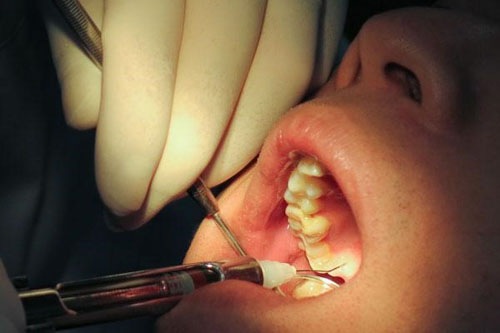 Hướng xử lý cho các trường hợp nhổ răng khôn bị nhiễm trùng
