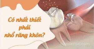 Read more about the article Khi nào nên nhổ răng khôn? Trường hợp cần phải nhổ