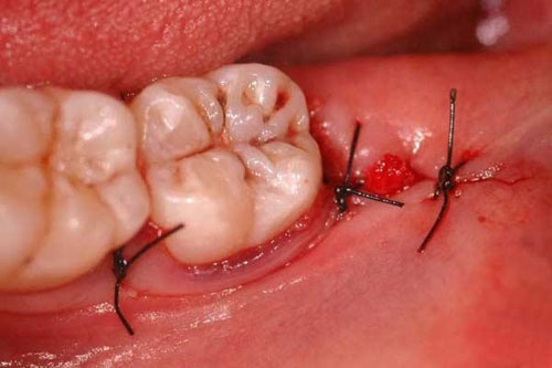 Lỗ hổng sau khi nhổ răng khôn xuất hiện sau cắt chỉ