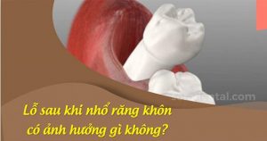 Read more about the article Lỗ sau khi nhổ răng khôn có ảnh hưởng gì không?