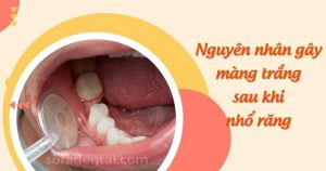 Read more about the article Màng trắng sau khi nhổ răng có nguyên nhân từ đâu?