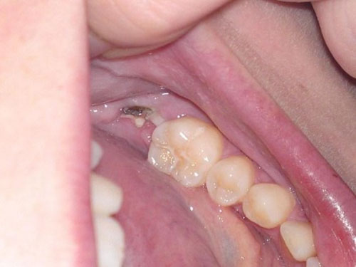 Màng trắng sau khi nhổ răng là gì?