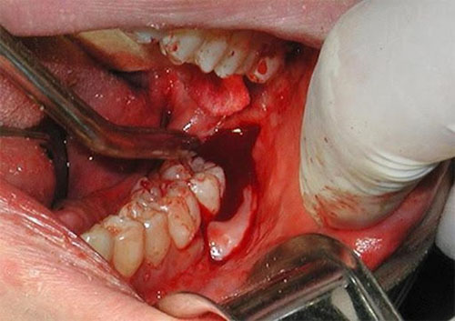 Nguyên nhân gây chảy máu sau khi nhổ răng khôn
