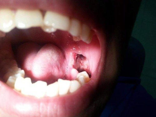 Nhiễm khuẩn sau khi nhổ răng số 8