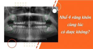 Read more about the article Nhổ 4 răng khôn cùng lúc có được không?