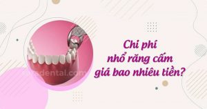 Read more about the article Nhổ răng cấm hết bao nhiêu tiền? Bảng giá mới nhất