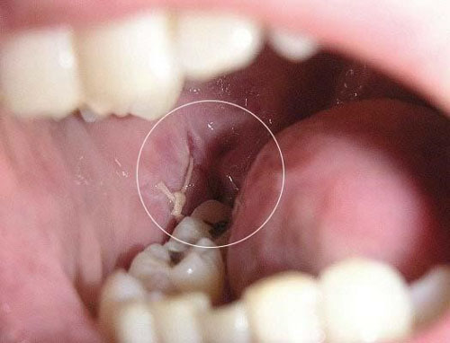 Những biến chứng khác sau khi nhổ răng khôn số 8