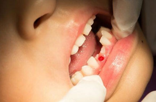 Những trường hợp cần nhổ răng cho trẻ