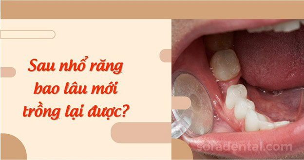 Read more about the article Sau nhổ răng bao lâu mới trồng răng giả lại được?