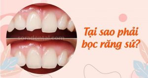 Read more about the article Tại sao phải bọc răng sứ sau khi chữa tủy?
