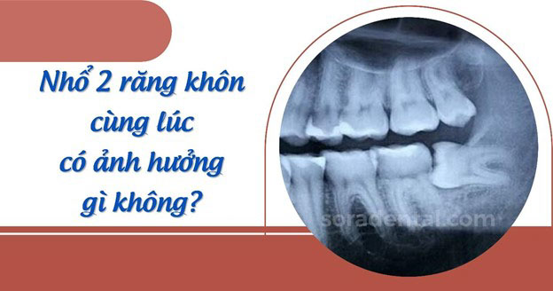 Read more about the article Nhổ 2 răng khôn cùng lúc có ảnh hưởng gì không?