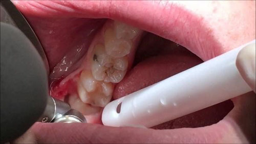 Tình trạng răng khôn mọc như thế nào