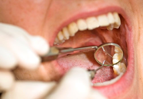 Viêm tủy răng sau khi bọc sứ