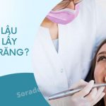 Bao lâu lấy cao răng 1 lần? Có nên lấy thường xuyên không?