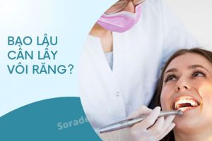 Read more about the article Bao lâu lấy cao răng 1 lần? Có nên lấy thường xuyên không?