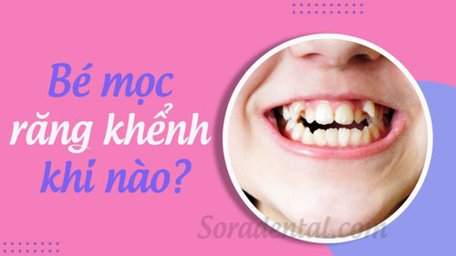 Read more about the article Bé mọc răng khểnh khi nào? Dấu hiệu mọc răng khểnh