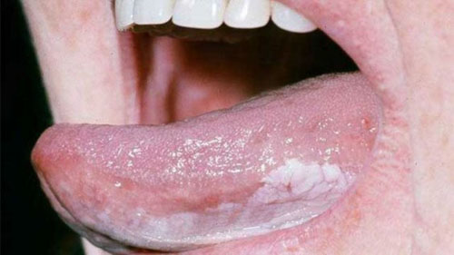 Bệnh bạch cầu (Leukoplakia) làm xuất hiện các mảng trắng dày trên lưỡi